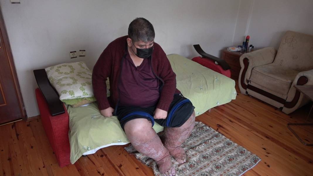 Sivrisinek, hayatının kabusu oldu! Öyle bir hastalığa yakalandı ki doktorlar çaresiz kaldı 14